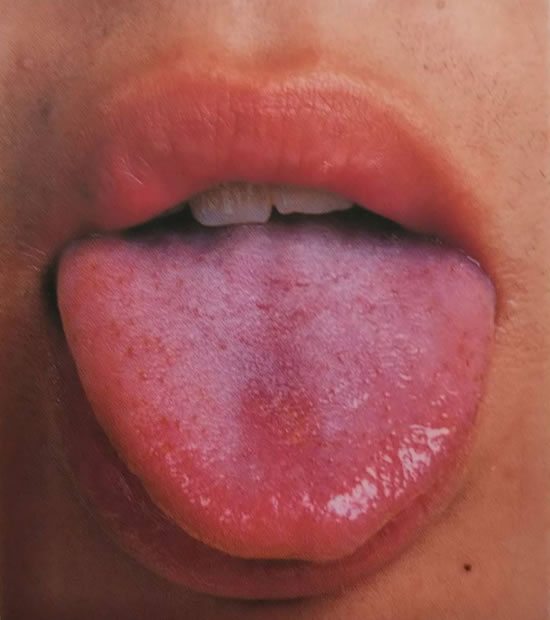 舌の画像サンプル